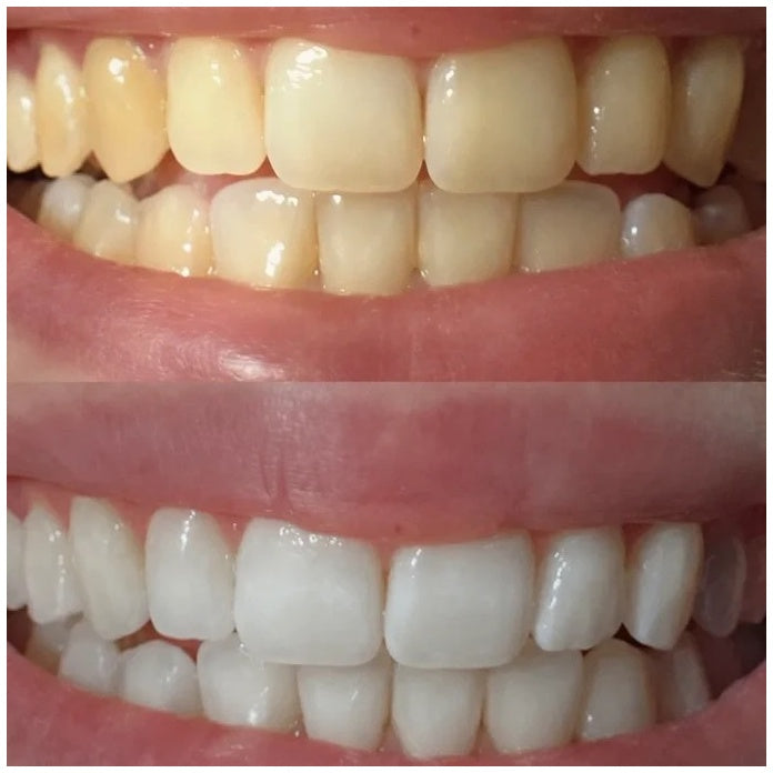 Teeth Whitening Strips (28 Strips)